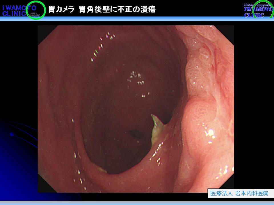 胃カメラ　胃角後壁に不正の潰瘍