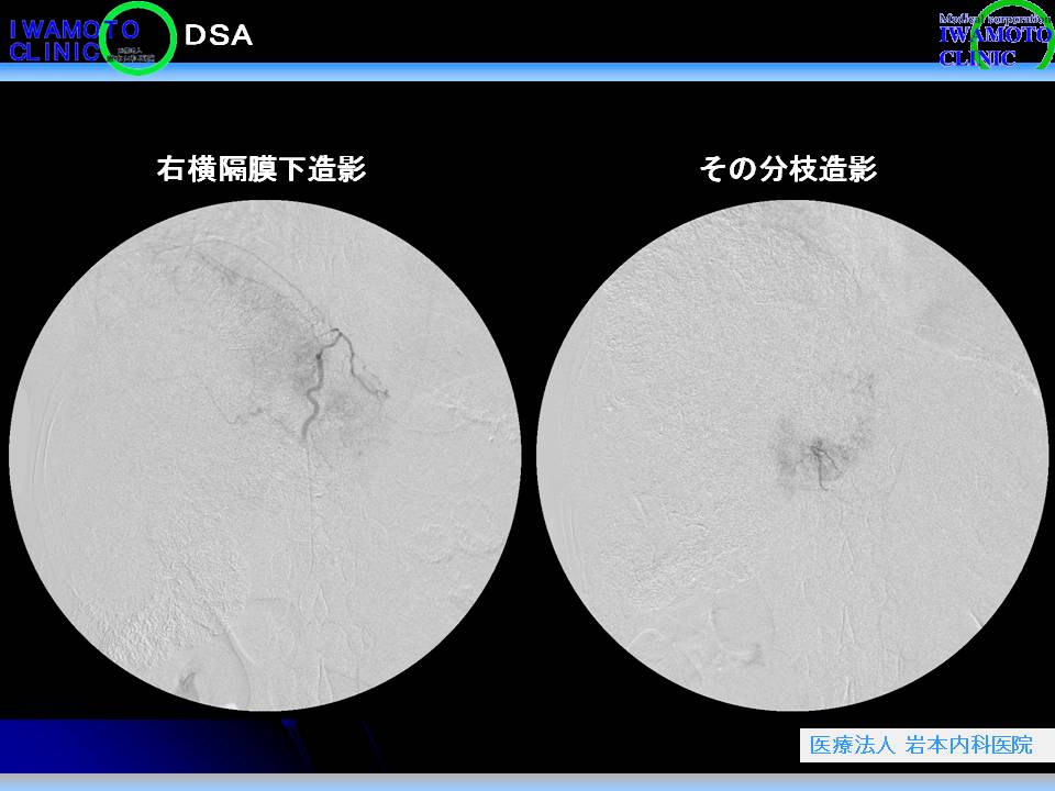 DSA 右横隔膜下動脈　その分枝造影