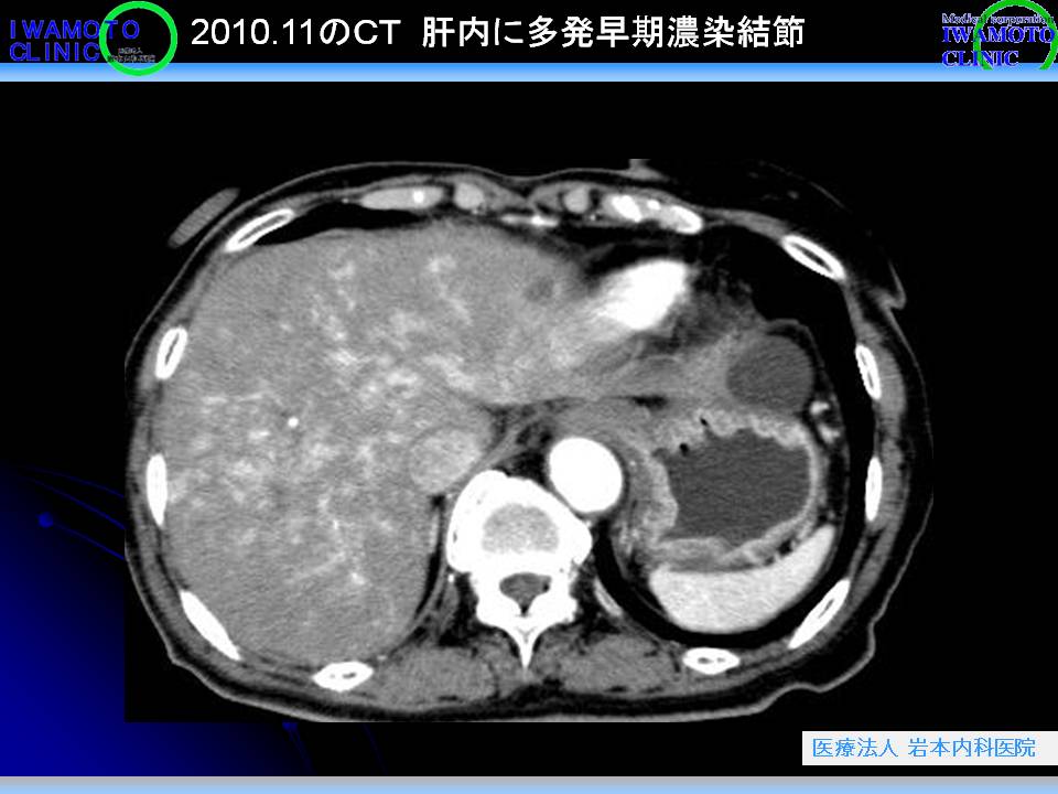 2010.11のＣＴ　肝内に多発早期濃染結節