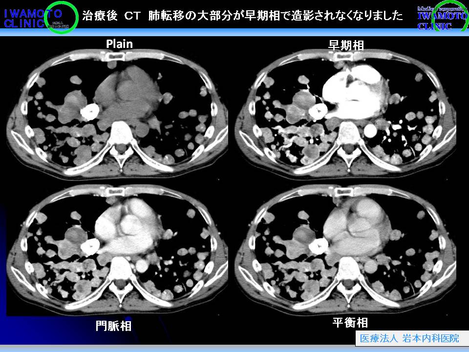治療後CT　肺転移の大部分が早期相で造影されなくなりました