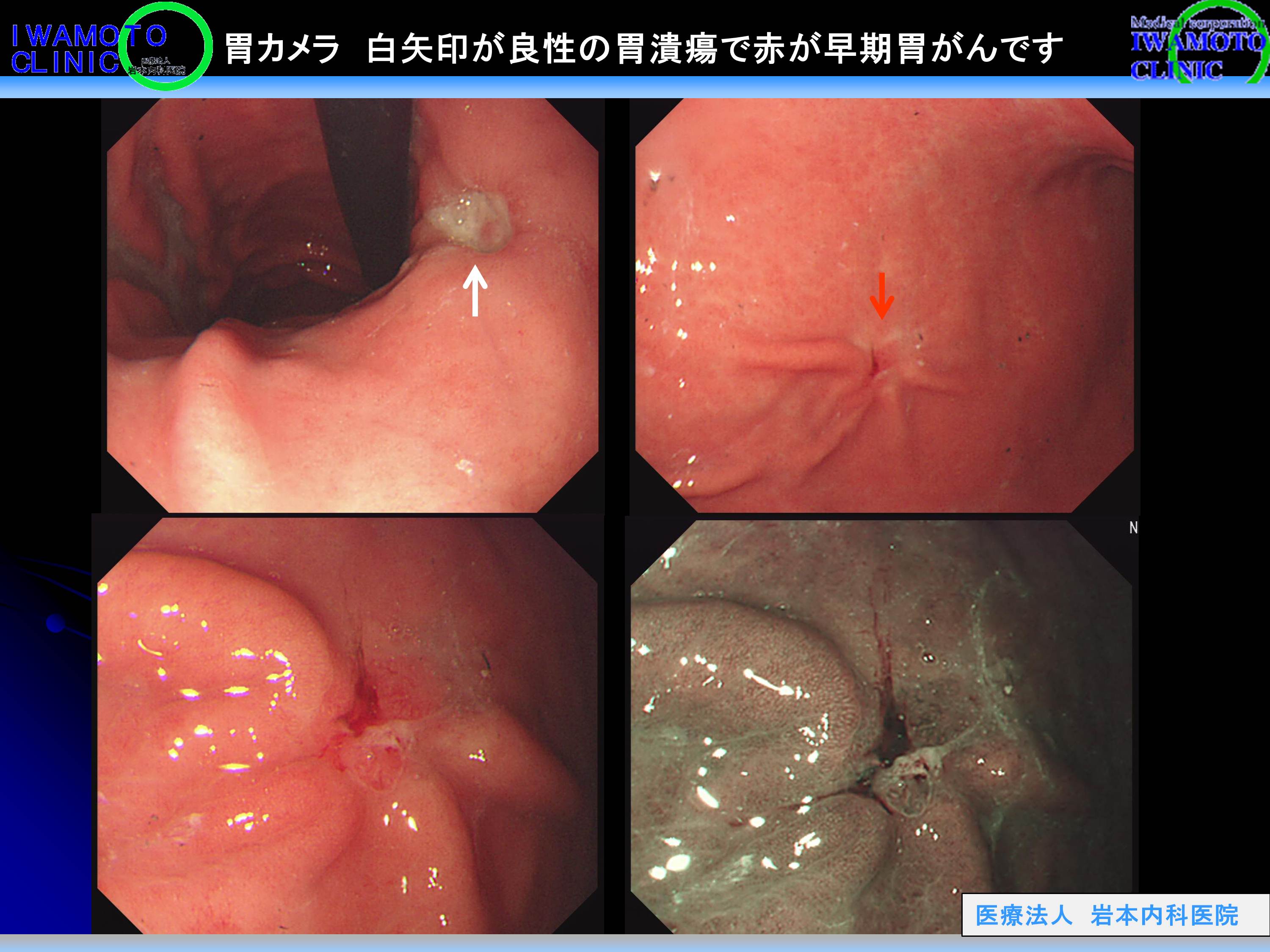 胃カメラ　白矢印が良性の胃潰瘍で赤が早期胃がんです